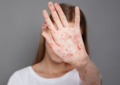 На Украине вспышка кори. Уже зафиксированы летальные исходы