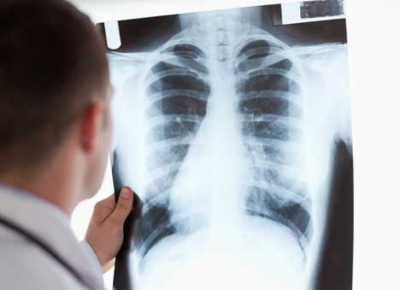 В Чехии активно распространяется туберкулез. Медики увязывают эпидемию с наплывом украинцев